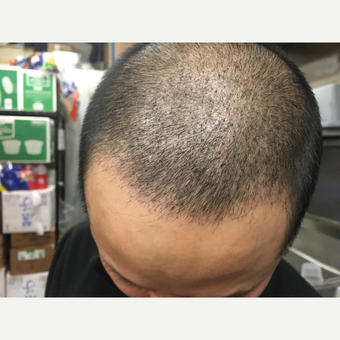 25-34 year old man treated with Hair Loss Treatment before 3618765