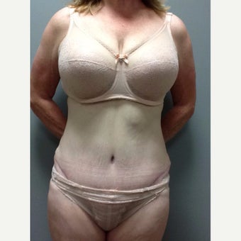 54 year old woman treated with Tummy Tuck after 2248217