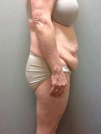 54 year old woman treated with Tummy Tuck 2248217