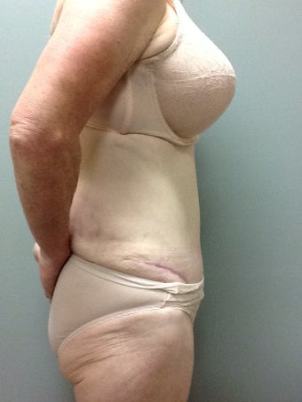 54 year old woman treated with Tummy Tuck 2248217