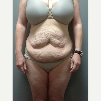 54 year old woman treated with Tummy Tuck before 2248217