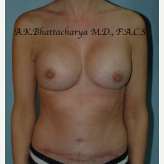 35-44 year old woman treated with Mommy Makeover after 3622365