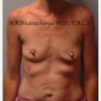 35-44 year old woman treated with Mommy Makeover before 3622365