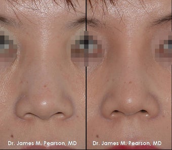 Rhinoplasty / Nasal Surgery before 910143