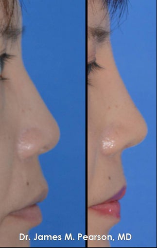 Rhinoplasty / Nasal Surgery after 910143