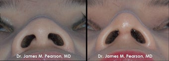 Rhinoplasty / Nasal Surgery 910143
