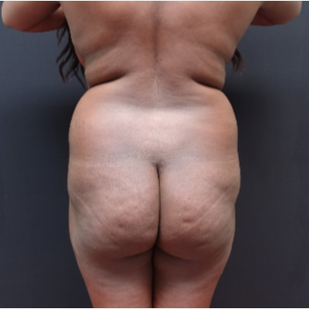25-34 year old woman treated with Fat Transfer before 3363844