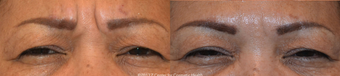 Botox for Treatment of Frown Lines before 1056281