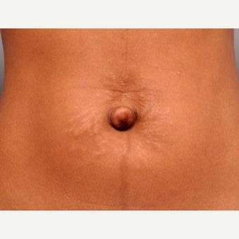 Belly Button Surgery before 1701135