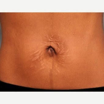 Belly Button Surgery after 1701135
