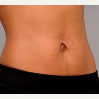 Belly Button Surgery 1701135