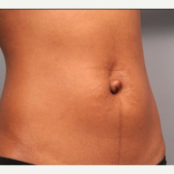 Belly Button Surgery 1701135