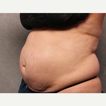 CoolSculpting - 57 Year Old Female before 2003872