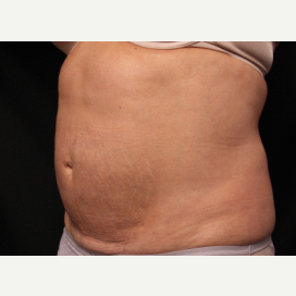 CoolSculpting - 57 Year Old Female after 2003872