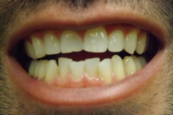 Young Male After ZOOM Teeth Whitening before 1010097