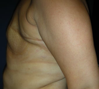 40 year woman for breast reconstruction with implants 1254603