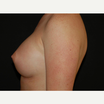 25-34 year old woman treated with Breast Implants after 3650993