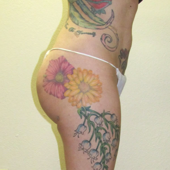 31 year old woman treated with Vaser Liposuction and fat injections to buttocks after 3624079