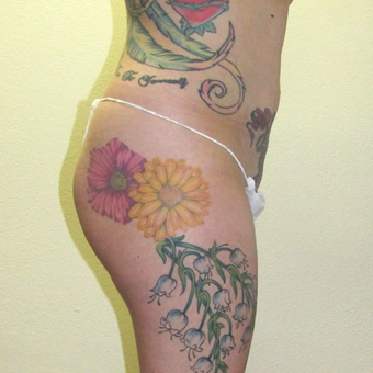 31 year old woman treated with Vaser Liposuction and fat injections to buttocks before 3624079