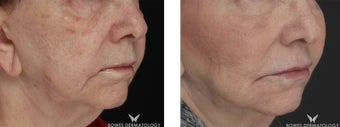 Juvederm Voluma restores volume and lifts the cheeks of 77-year-old patient before 1439314