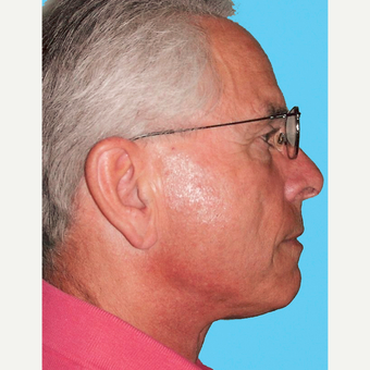 Neck Lift after 3824720