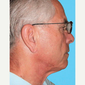 Neck Lift before 3824720