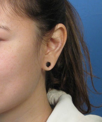 Gauge Earring Defect Repair 1057662