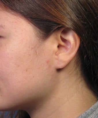 Gauge Earring Defect Repair after 1057662