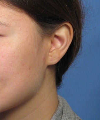 Gauge Earring Defect Repair 1057662