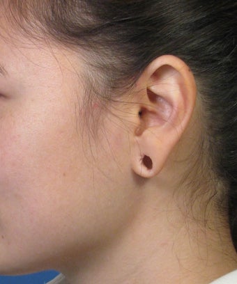 Gauge Earring Defect Repair before 1057662