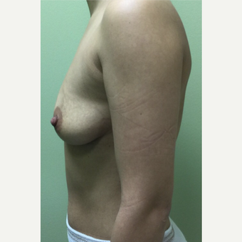 18-24 year old woman treated with Breast Augmentation before 3400716