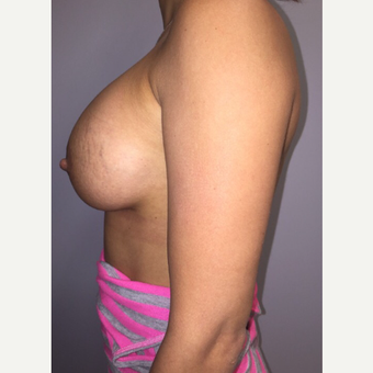 18-24 year old woman treated with Breast Augmentation after 3400716