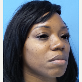 35-44 year old woman treated with African American Rhinoplasty after 3169273
