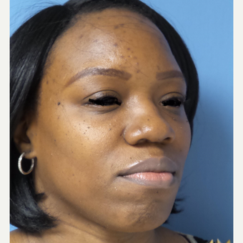 35-44 year old woman treated with African American Rhinoplasty before 3169273