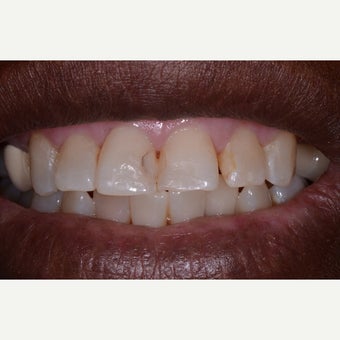 55-64 year old woman treated with Tooth Repair before 2511415