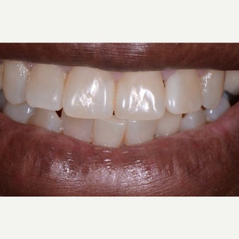 55-64 year old woman treated with Tooth Repair after 2511415