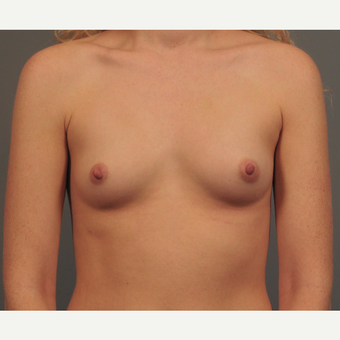25-34 year old woman treated with Breast Augmentation before 3344407