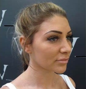 Fixing 'trout pout' lips with with Hyalase injections after 3376560