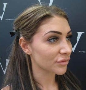 Fixing 'trout pout' lips with with Hyalase injections before 3376560