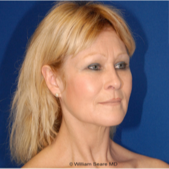 Cheek Augmentation with Natural Fat Transfer after 3104783