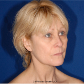 Cheek Augmentation with Natural Fat Transfer before 3104783