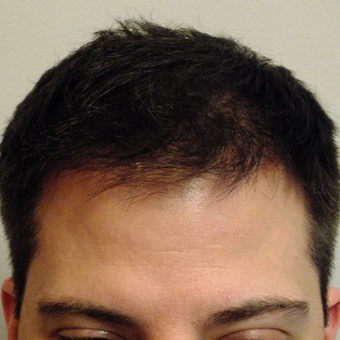 25-34 year old man treated with ARTAS Robotic Hair Transplant after 2830837