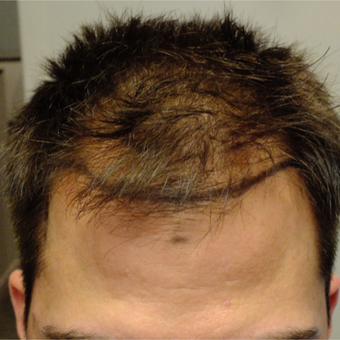 25-34 year old man treated with ARTAS Robotic Hair Transplant before 2830837