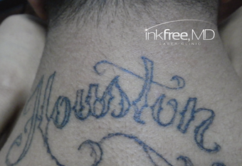 18-24 year old man treated with Laser Tattoo Removal (Marine) before 3778966