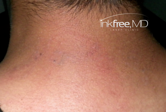 18-24 year old man treated with Laser Tattoo Removal (Marine) after 3778966