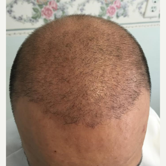 18-24 year old man treated with NeoGraft after 3325613