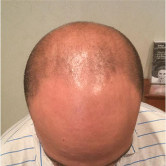 18-24 year old man treated with NeoGraft before 3325613