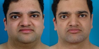 30-year-old man treated with Chin and Jawline Enhancement. before 3265762