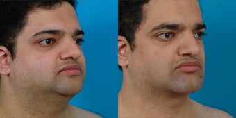 30-year-old man treated with Chin and Jawline Enhancement. after 3265762