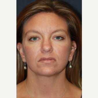 34 year old woman treated with Lower Face Lift after 3629184